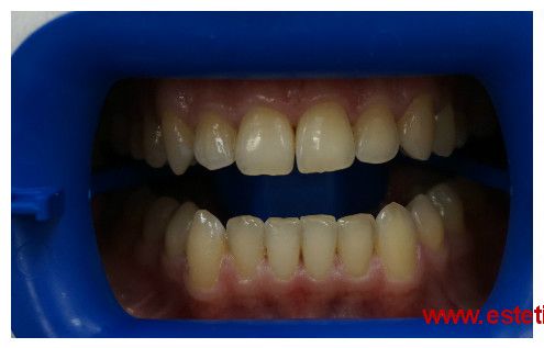 отбеливание_зубов_1