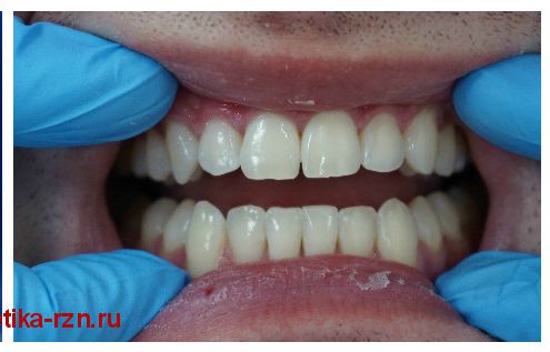 отбеливание_зубов_2