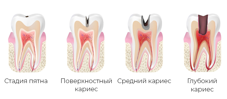 Стадии кариеса